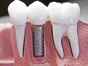 「第二の永久歯」とも言われるインプラント治療
