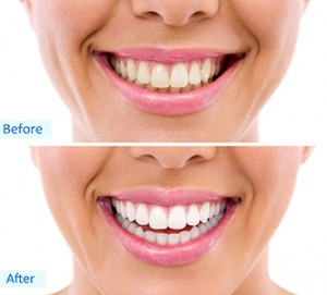 whitening - bleaching treatment ,before and after ,woman teeth and smile, close up, isolated on white